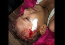 6 साल के मासूम पर आवारा कुत्ते ने किया जानलेवा हमला, गंभीर हालत में एम्स में भर्ती, सिर पर लगे हैं 20 टांके stray-dog-bite-child