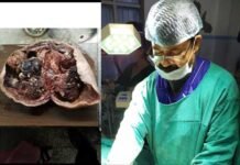 3 माह से परेशान पौड़ी की युवती के साढ़े 3 किलों के दुर्लभ ट्यूमर का डॉ. टम्टा ने किया सफल ऑपरेशन tumor-of-3-and-a-half-forts