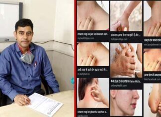 साफ-सफाई का अभाव और सघन रहन-सहन है त्वचा रोग का कारण : डा. अभिषेक दुबे Cause-of-skin-disease