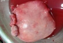 गर्भाशय से निकाली साढ़े तीन किलो की रसौली 3 and half kg neoplasm removed from uterus