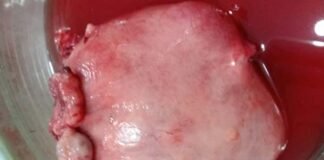 गर्भाशय से निकाली साढ़े तीन किलो की रसौली 3 and half kg neoplasm removed from uterus