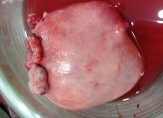 गर्भाशय से निकाली साढ़े तीन किलो की रसौली 3 and half kg neoplasm removed from uterus