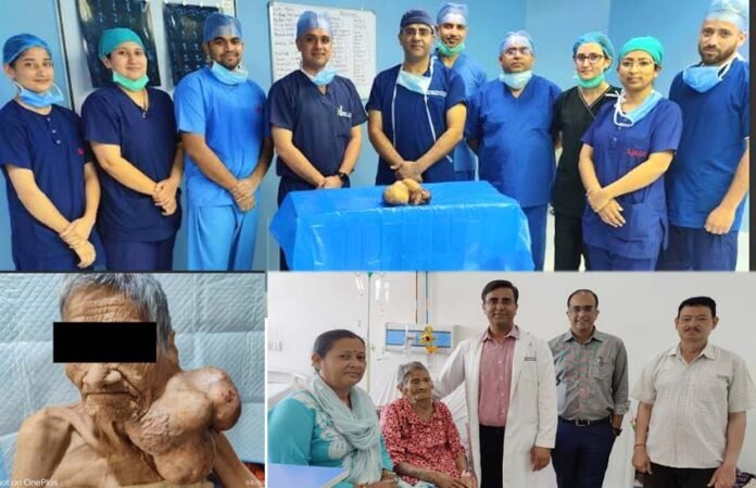 1.5 kg tumor removed from 91-year-old woman throat