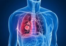 Lungs कैंसर की मिली रामबाण दवा!, कितनी है असरदार, रिसर्च में वैज्ञानिकों ने किया बड़ा दावा lungs cancer