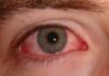 तेजी से बढ़ रहा है Eye Flu, उत्तराखंड में आई फ्लू को लेकर गाइडलाइन जारी, जानिए लक्षण और बचाव के उपाय eye flu symptoms and treatment