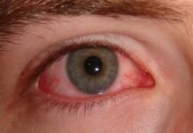 तेजी से बढ़ रहा है Eye Flu, उत्तराखंड में आई फ्लू को लेकर गाइडलाइन जारी, जानिए लक्षण और बचाव के उपाय eye flu symptoms and treatment