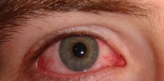 तेजी से बढ़ रहा है Eye Flu, उत्तराखंड में आई फ्लू को लेकर गाइडलाइन जारी, जानिए लक्षण और बचाव के उपाय eye flu symptoms and treatment