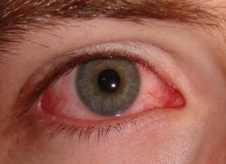 तेजी से बढ़ रहा है Eye Flu, उत्तराखंड में आई फ्लू को लेकर गाइडलाइन जारी, जानिए लक्षण और बचाव के उपाय eye flu symptoms and treatment