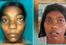 12 साल पुराने चेहरे के ट्यूमर से मिली मुक्ति, शारदा हॉस्पिटल ने बिना निशान की सर्जरी से 22 वर्षीय युवती को दी नई जिंदगी scarless surgery on a 22-year-old woman for a 12-year-old facial tumor