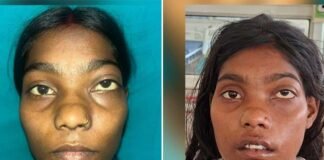 12 साल पुराने चेहरे के ट्यूमर से मिली मुक्ति, शारदा हॉस्पिटल ने बिना निशान की सर्जरी से 22 वर्षीय युवती को दी नई जिंदगी scarless surgery on a 22-year-old woman for a 12-year-old facial tumor