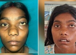 12 साल पुराने चेहरे के ट्यूमर से मिली मुक्ति, शारदा हॉस्पिटल ने बिना निशान की सर्जरी से 22 वर्षीय युवती को दी नई जिंदगी scarless surgery on a 22-year-old woman for a 12-year-old facial tumor